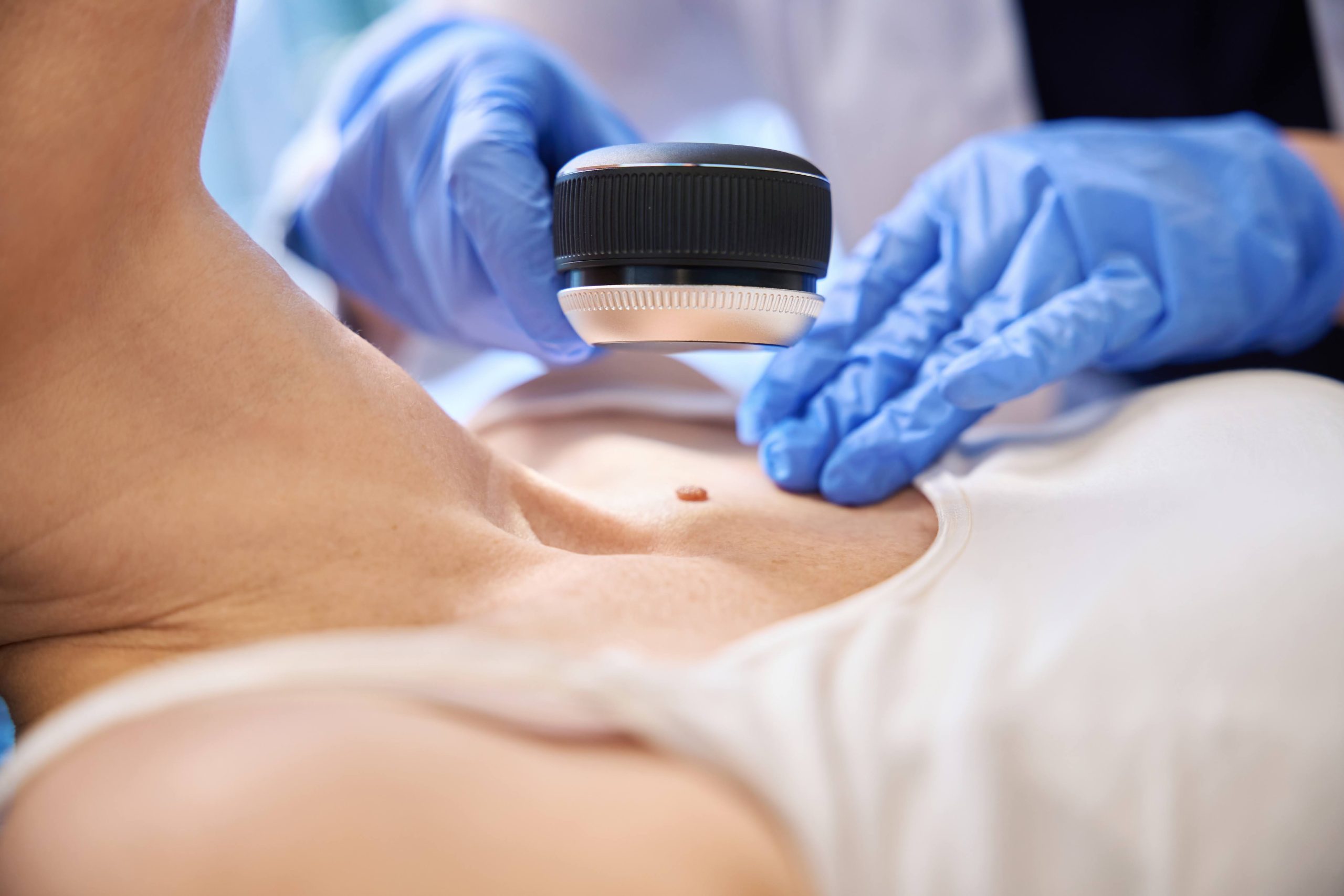 Огляд родимки дерматоскопом